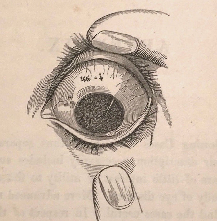 GUIDE TO THE PRACTICAL STUDY OF DISEASES OF THE EYE - Dixon, 1st/1st US Ed, 1860